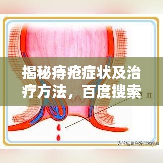 揭秘痔疮症状及治疗方法，百度搜索结果全解析！